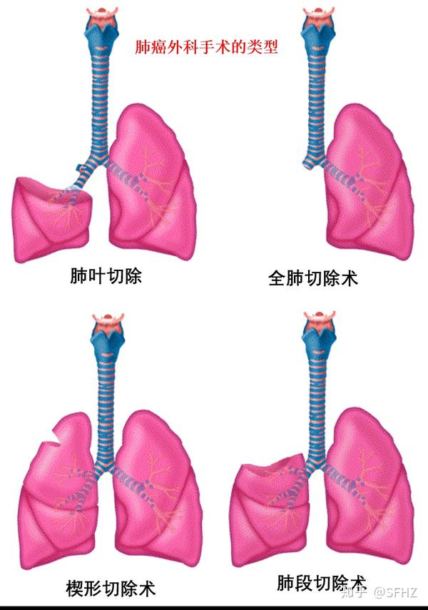 如果可以的话那么肺叶切除是首选的手术操作,因为相比肺段或楔形切除