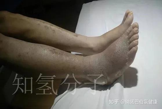 糖尿病足氢干预有效吗