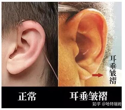 03耳垂褶皱 罹患冠状动脉硬化的人,耳垂上几乎都有一条皱纹,也叫"