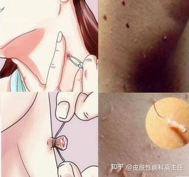 丝状疣会通过母乳传染给孩子吗?