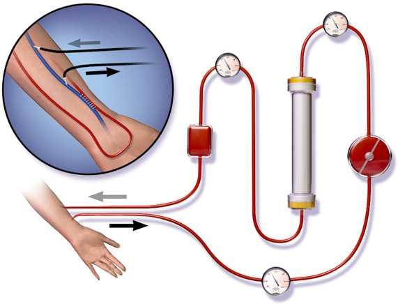 血液透析治疗必须要求血液在体外循环,因此,需要有通路将血液引流