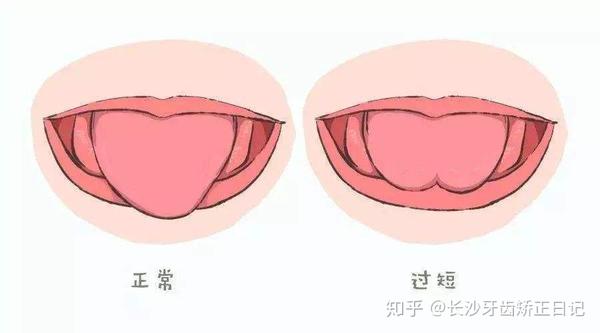 唇腭裂术后