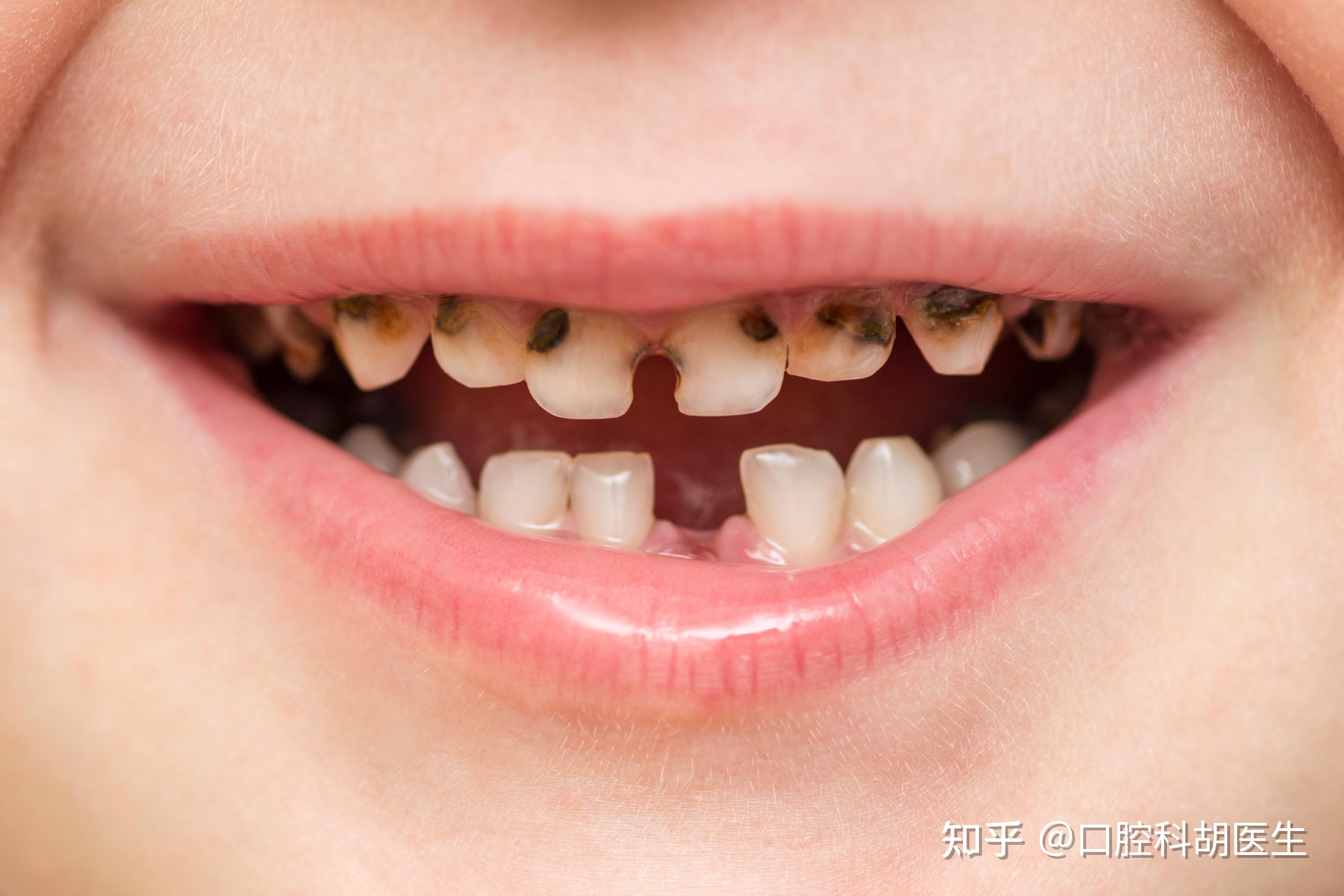 小孩子到了换牙齿的年龄,一天之中哪个时间段去拔牙最佳?