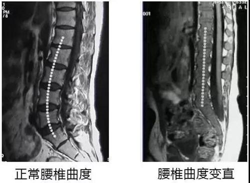 腰椎曲度变直了,咋整呢?