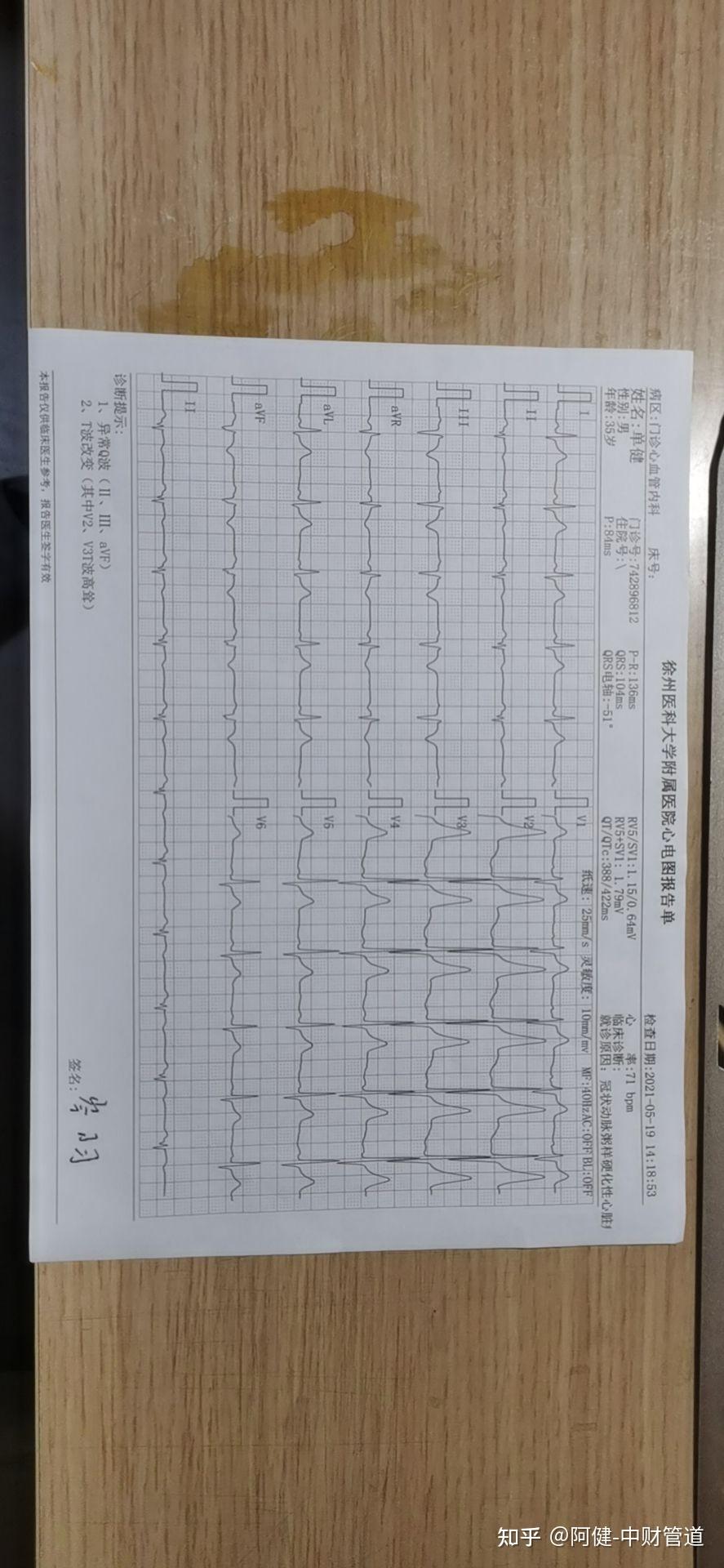 专业人士可以帮我看一下这心电图恢复的怎么样吗