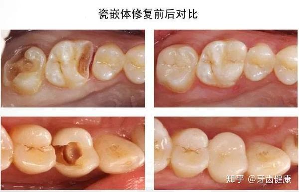 5,邻面缺损采用瓷嵌体修复,可以用最少量的磨牙方式来达到瓷冠套同样