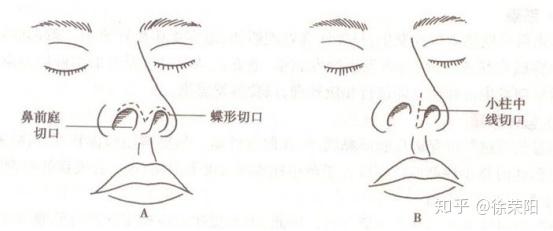 鼻梁塌陷如鞍鼻,塌鼻;鼻尖软骨发育不足如朝天鼻,蒜头鼻;以三庭五眼为