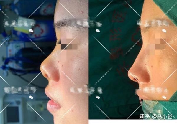 隆鼻审美微驼峰鼻最全功课全国擅长驼峰鼻的隆鼻医生盘点附案例