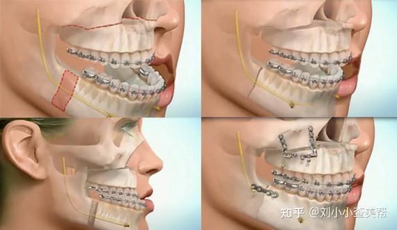 花十多万做正颌手术真的值得吗