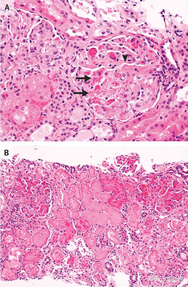 进一步肾活检提示tma表现(箭头,红细胞碎片)以及皮质肾小管坏死