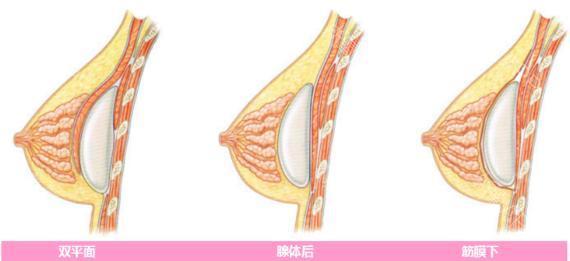 戏说女人丰胸史假体隆胸如何选择适合自己的假体