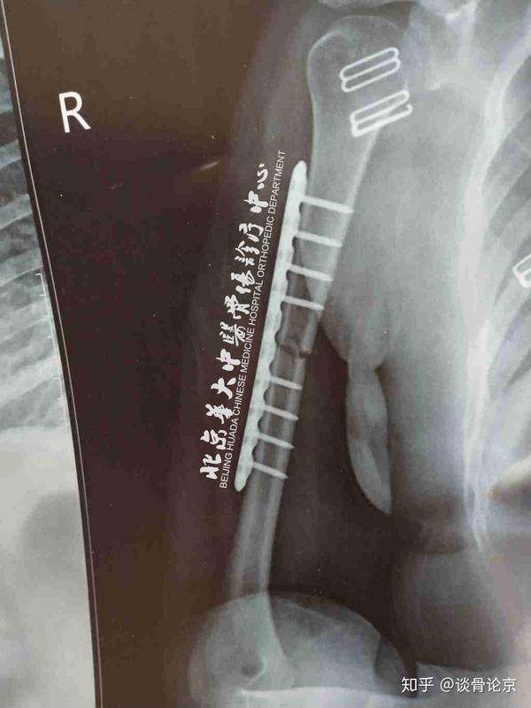 用药28天后复查,患者x光片显示:骨折线开始模糊,骨痂生成,骨密度提高