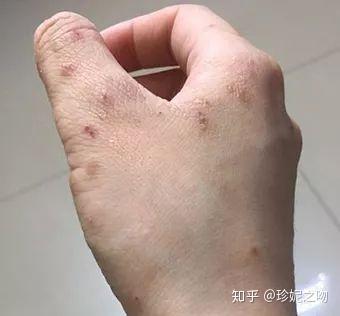 夏天是皮肤病的高发期,环境湿热,蚊虫细菌传播,再加上天气让体内燥热