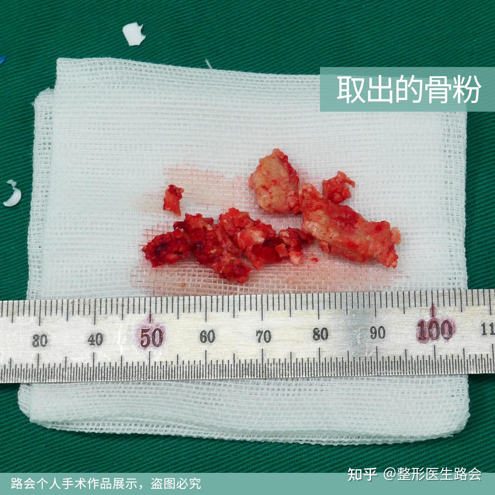 骨粉隆鼻7年皮肤薄如纸很多医生都说做不了她该怎么办
