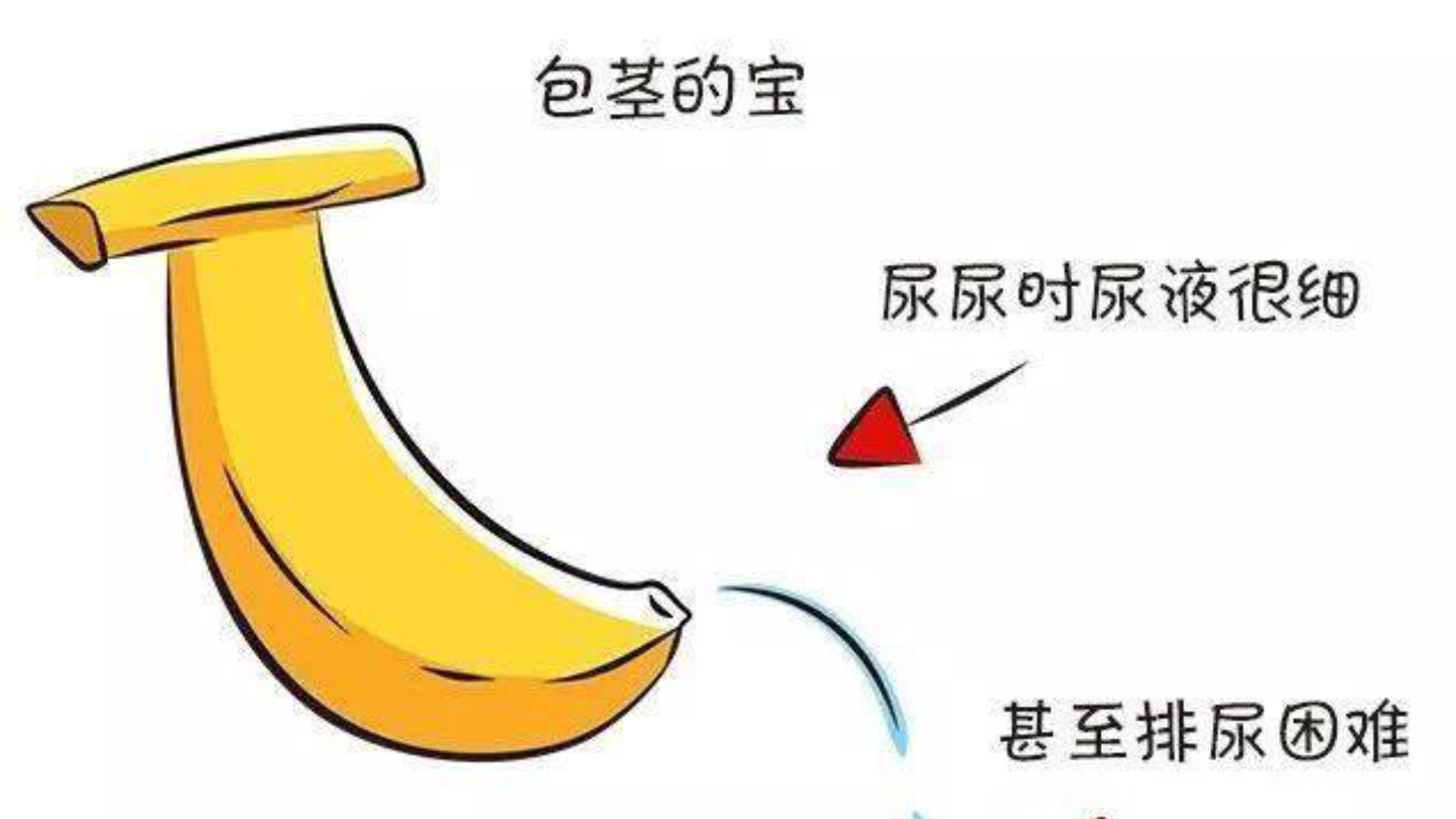 儿子包茎手术前后纪实(01),将亲身经历告诉各位宝爸宝妈