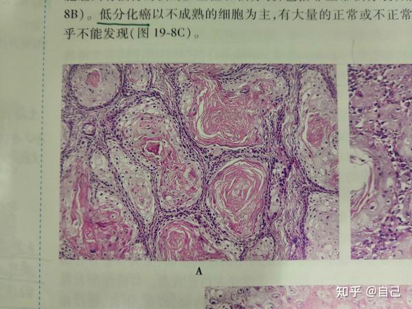 高分化鳞状细胞癌红蓝铅笔