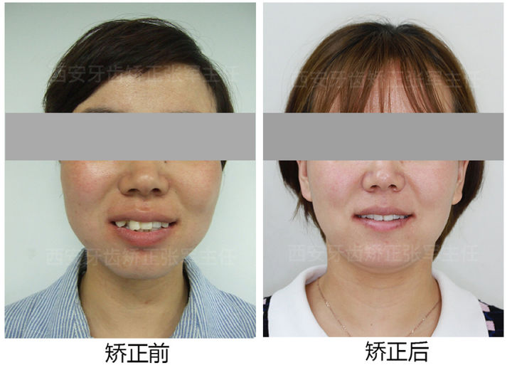 西安牙齿矫正凸嘴拉垮颜值侧颜凸嘴形象不满意怎么办