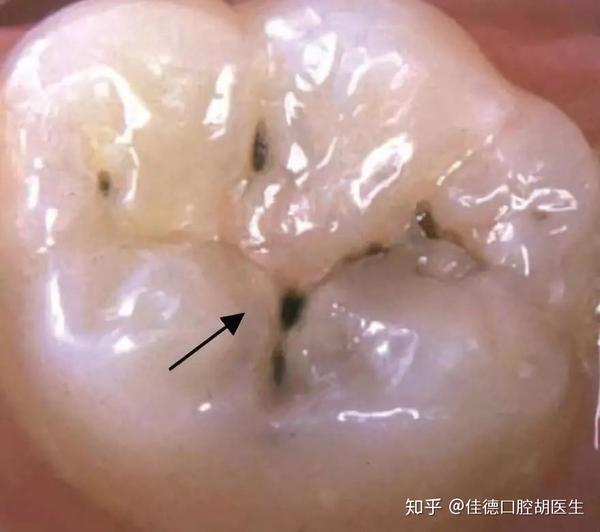 表面的再矿化的牙釉质,唾液都进不去了,更别说刷毛了,根本也刷不到的