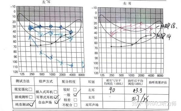右耳人工耳蜗(ci,助听后听阈在25 dbhl