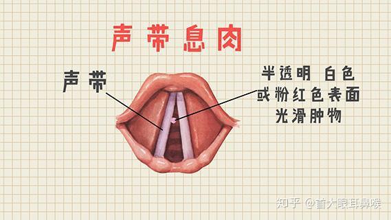 首大崔付军:声带息肉有哪些治疗方案