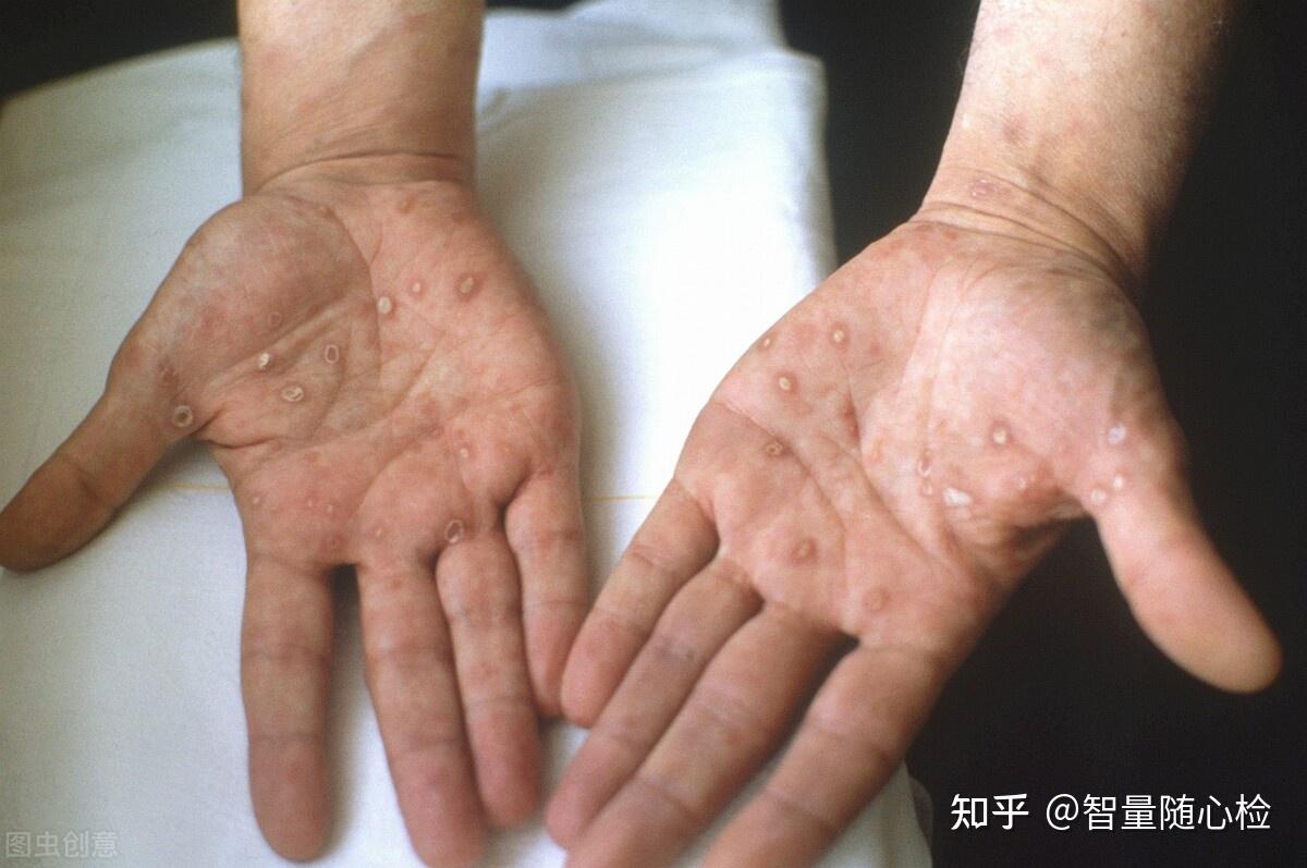 皮肤损害为二期梅毒的主要损害,其表现形态多种多样,可为斑疹,斑丘疹