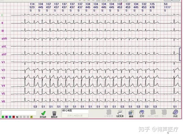 博声医疗:房速,房性心动过速