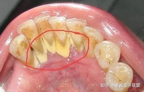 牙缝里抠出的黄色物质到底是什么?为啥会那么臭?