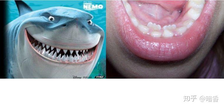 [001 鲨鱼牙shark tooth怎么长出来的]