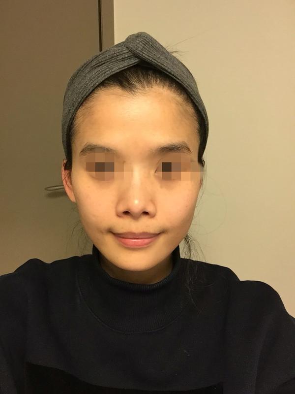 还不了解什么是vline磨骨,我跟她说vline磨骨手术就可以改善下巴,她也