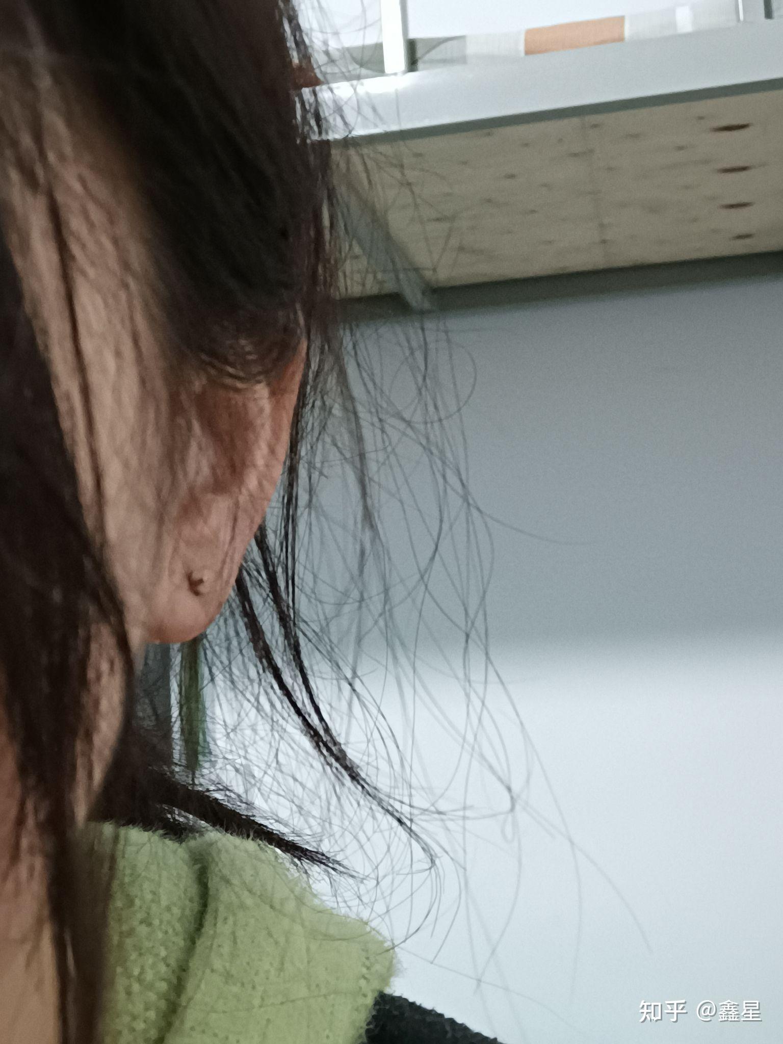 耳洞结痂戴不进耳钉怎么办