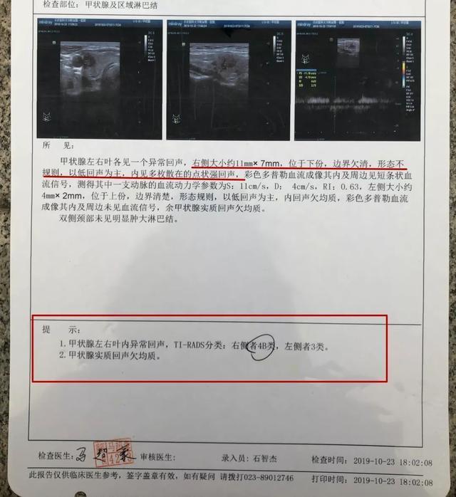【真实案例】记录桥本氏甲状腺炎影响甲状腺功能过程