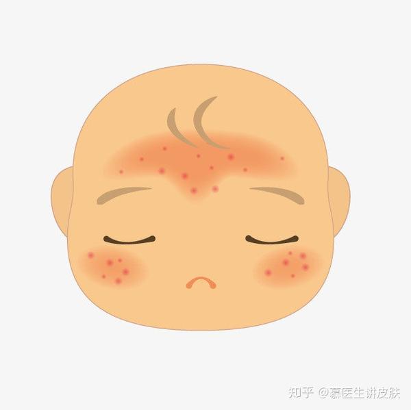 全年龄段疾病:特应性皮炎,从婴儿期,儿童期,青少年到成人期