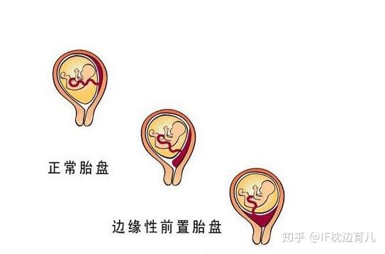 怀孕4个月孕妈一直在干活和胎盘后壁有关系吗科学解释在这里