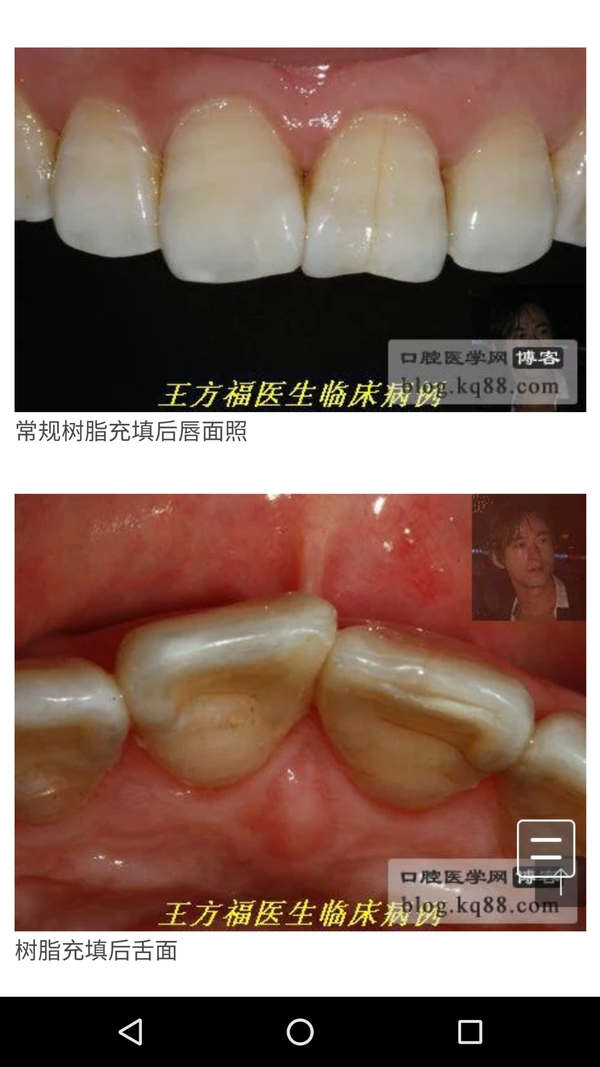 牙齿烂到什么程度需要做牙冠