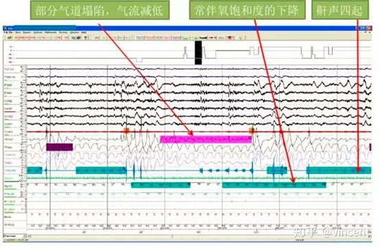 多导联睡眠呼吸监测psg解读