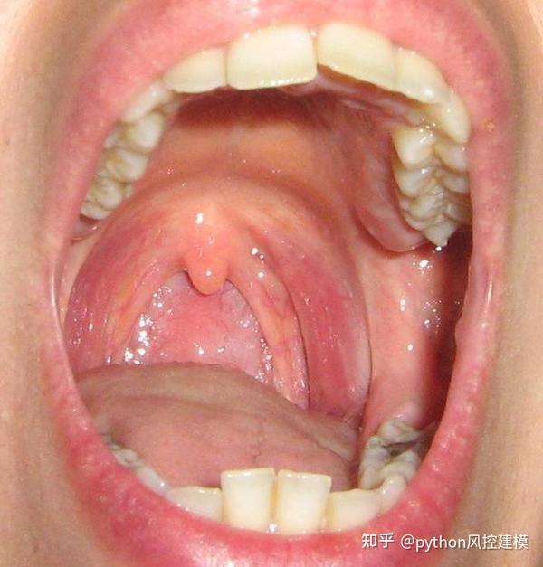 扁桃体感染如下图  a healthy throat:健康咽喉 laryngitis:喉炎