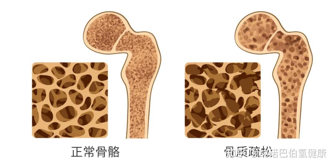 摔了一跤竟骨折了?老年人骨质疏松,氢气来助!