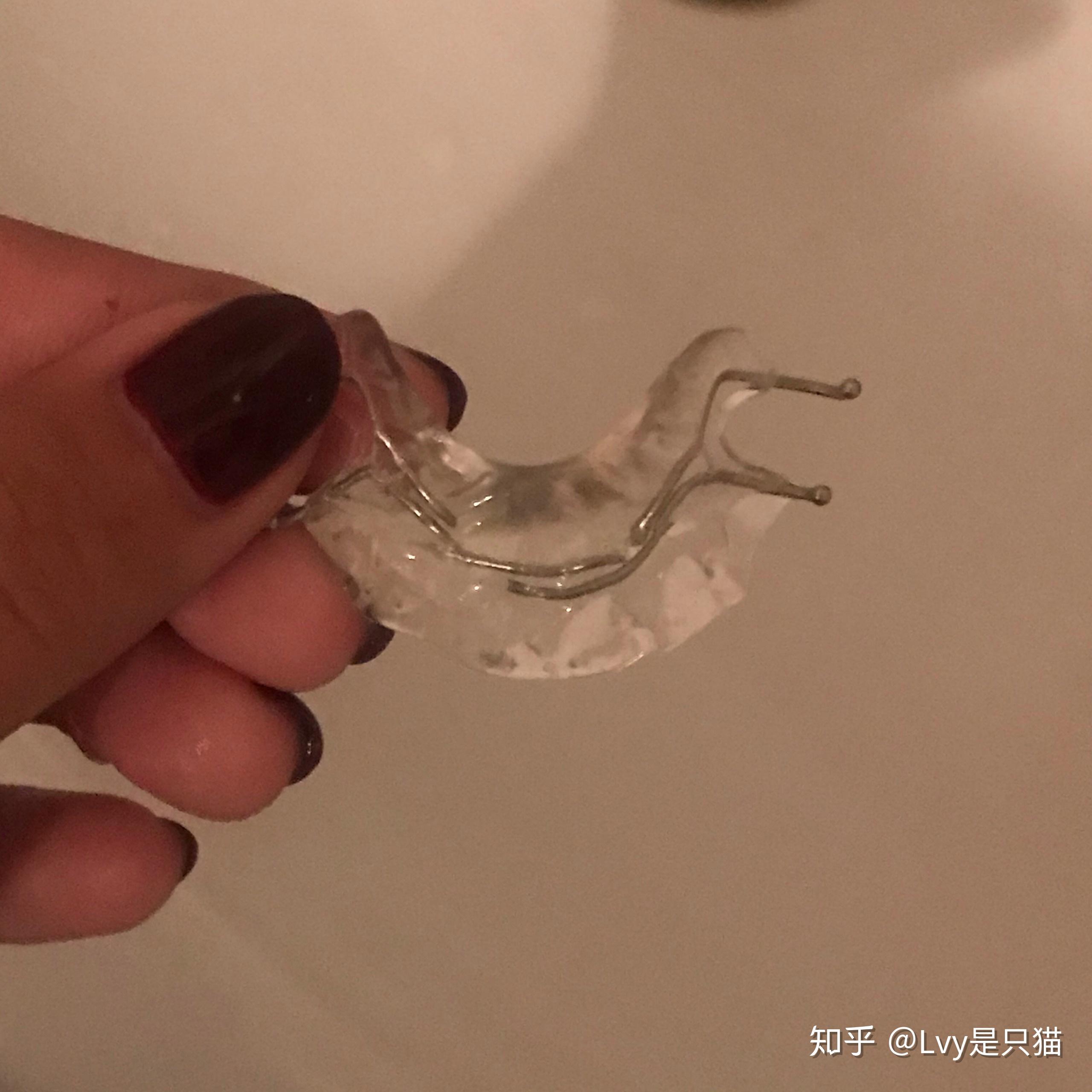 牙齿正畸戴平导的体验