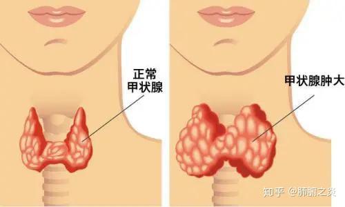 甲状腺囊肿是什么原因导致的?怎么治疗?