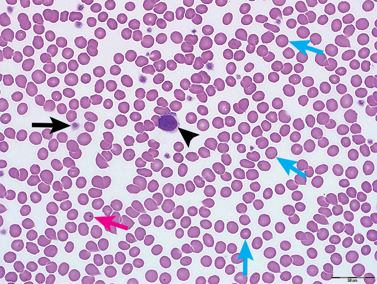 临床病理学图谱血涂片中红细胞判读