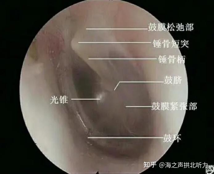 怎么判断自己耳膜有没有破裂