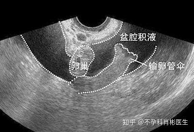 盆腔积液影响怀孕吗怀孕初期得病怎么办