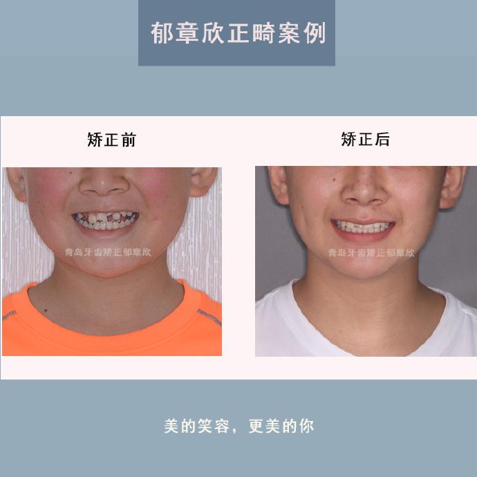 青岛牙齿矫正:「牙齿拥挤,错乱」整牙案例