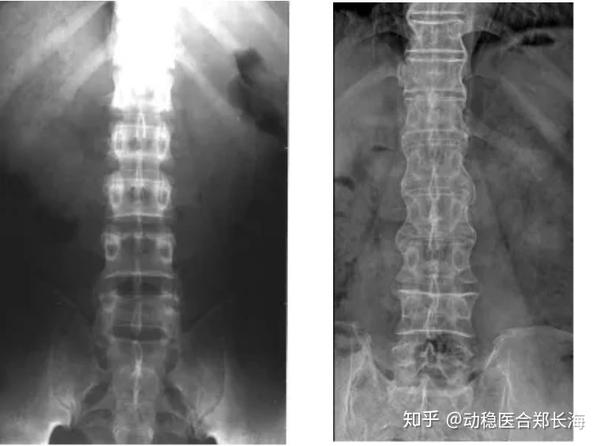 ③脊柱明显骨质疏松,骨质疏松后使其强度下降,轻微外伤即可导致骨折.