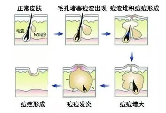 寻常痤疮病因病机是什么?中西医结合如何治疗?