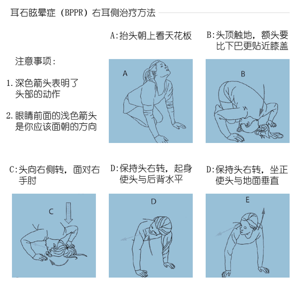 眩晕症(耳石症/vertigo)的最新自我治疗方法