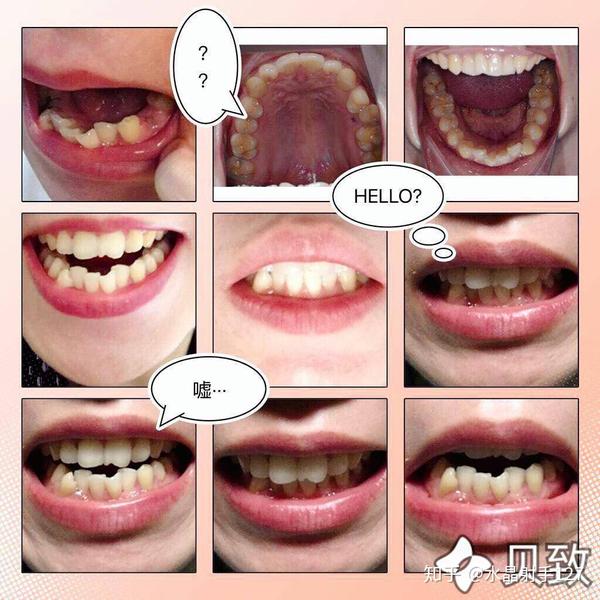 慢慢戒了很多零食. 3,牙齿变整齐很多. 有一颗瓜子牙,就是