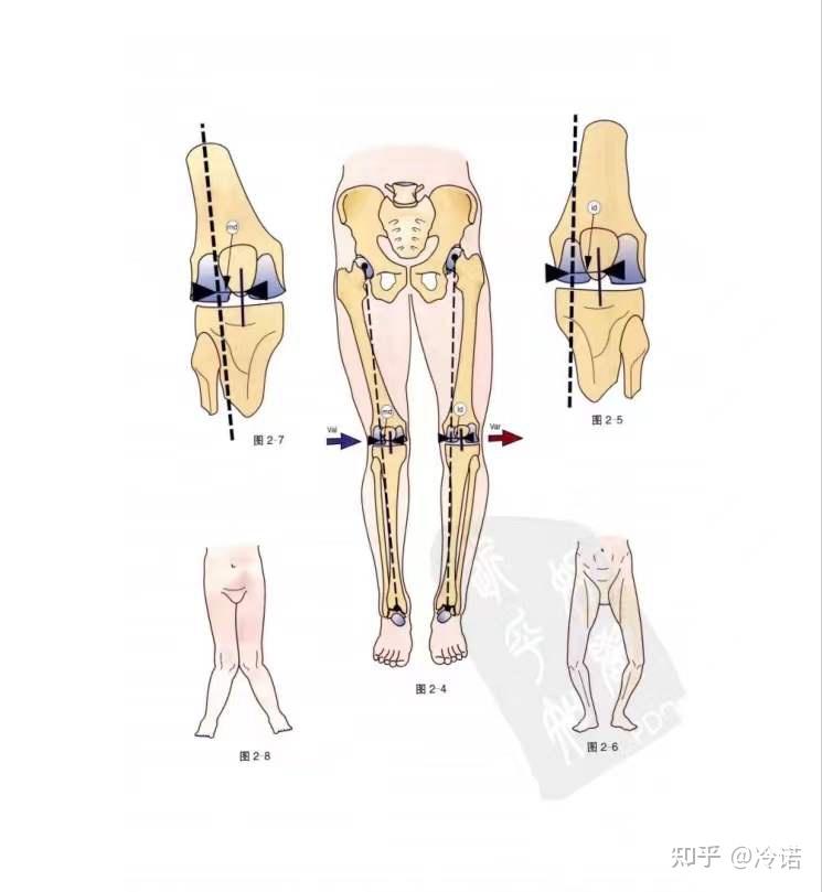 如何从解剖学的角度解释一下膝内翻膝外翻足内翻足外翻的定义及成因