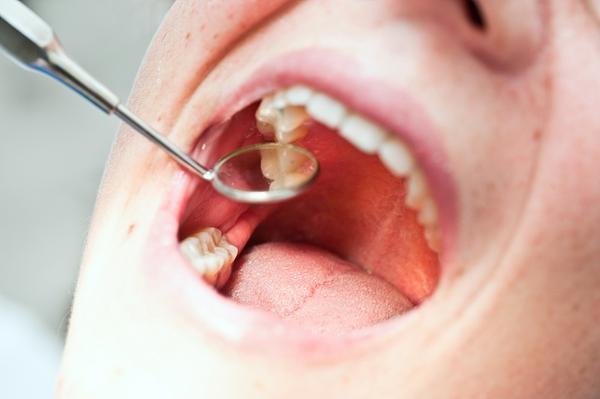 了解补牙之前,我们先来了解一下我们正常的牙齿是怎么样的.