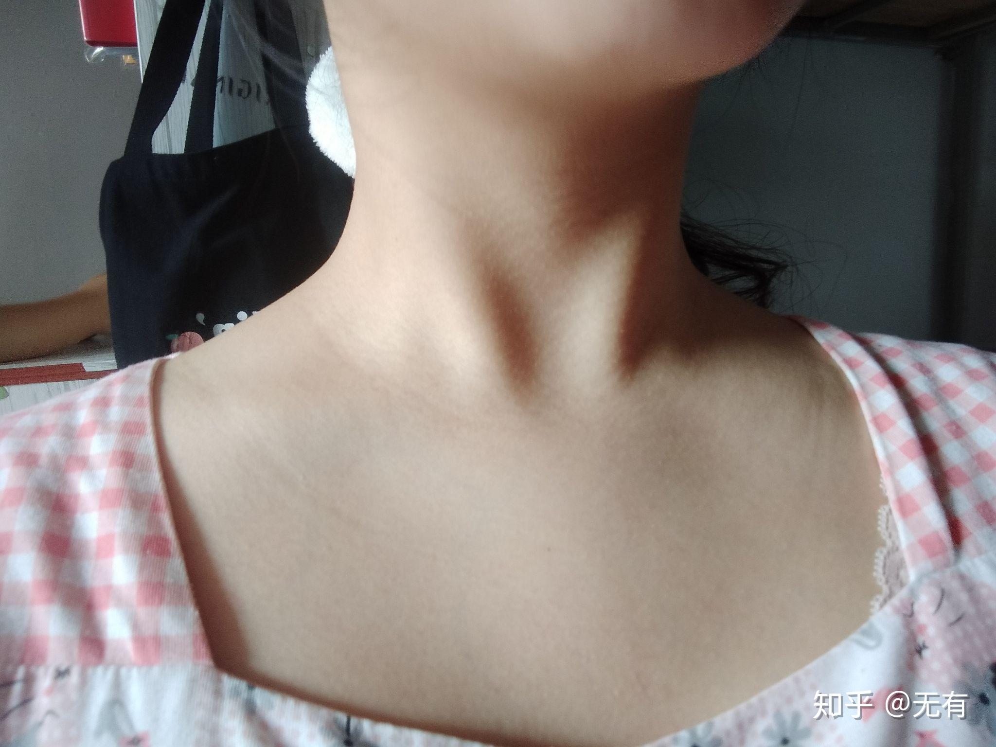 别人颈纹是长在脖子上而我却在锁骨与脖子连接处长了两道圈请问这是
